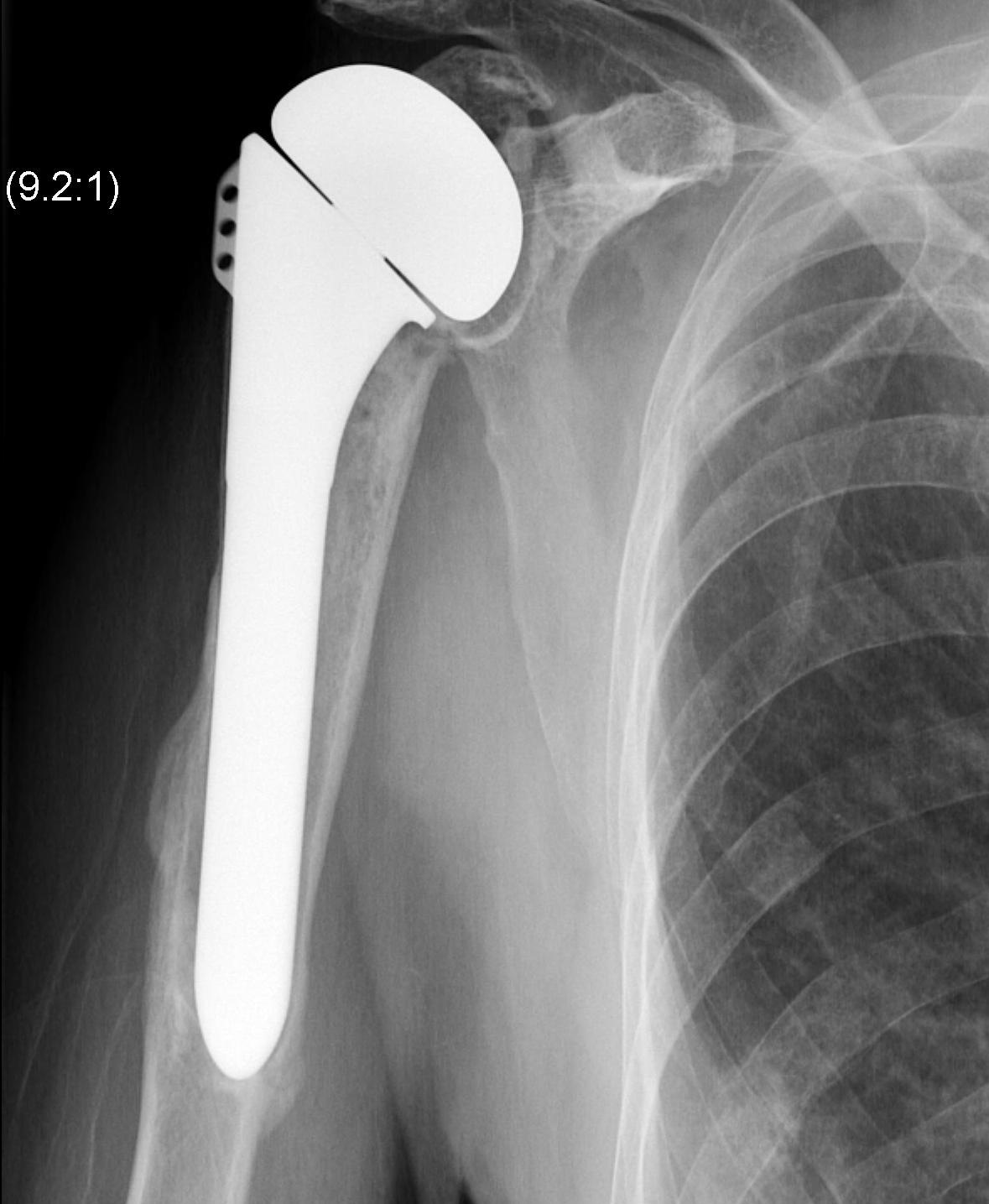 TSR Humeral Fracture United